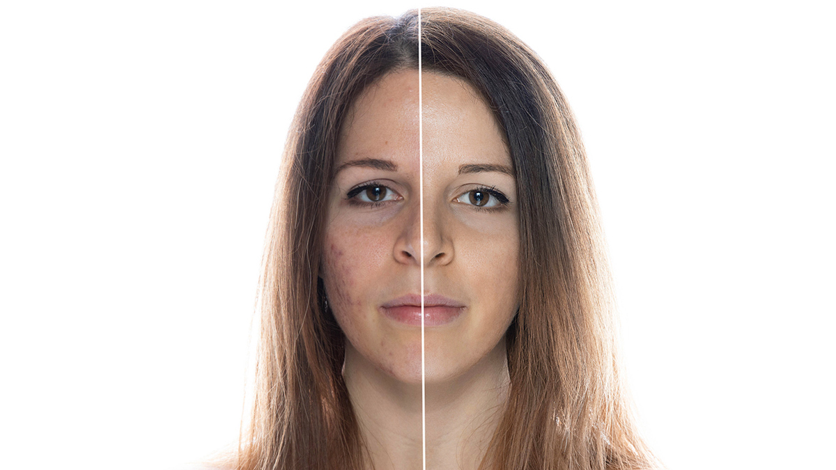 Skin care tips : बढ़ते प्रदूषण से बेहाल है त्वचा? ये 5 स्टेप्स करें फॉलो, कील मुंहासे हो जाएंगे छूमंतर!