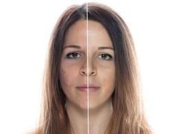 Who Knew? Raisin Water Might Just Be Your New Acne-Busting BFF