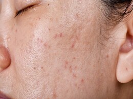 चेहरे पर नजर आती है चिपचिपाहट तो तुरंत आजमाकर देख लें ये 6 तरीके, Oily Skin की दिक्कत हो जाएगी दूर  चेहरे पर नजर आती है चिपचिपाहट तो तुरंत आजमाकर देख लें ये 6 तरीके, Oily Skin की दिक्कत हो जाएगी दूर