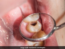 दांतों में लगे कीड़े हटाने के लिए करें यह काम, कैविटी होगी दूर और चमकने लगेंगे दांत दांतों में लगे कीड़े हटाने के लिए करें यह काम, कैविटी होगी दूर और चमकने लगेंगे दांत