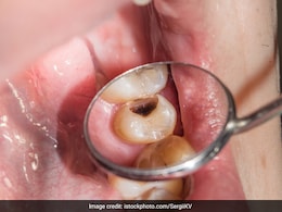 दांतों में कैविटी और दर्द से कैसे पाएं छुटकारा? आज जान लें दांत की सड़न ठीक करने का रामबाण तरीका दांतों में कैविटी और दर्द से कैसे पाएं छुटकारा? आज जान लें दांत की सड़न ठीक करने का रामबाण तरीका