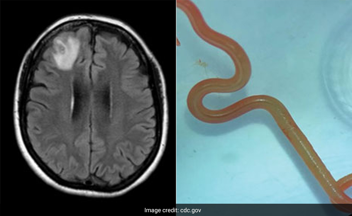 Live Parasitic Worm Found In Australian Woman's Brain In World-First Discovery