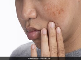 चेहरे के गहरे धब्बे इन 2 चीजों को लगाने पर होने लगेंगे हल्के, हफ्ते में बस एक बार करना होगा इस्तेमाल  चेहरे के गहरे धब्बे इन 2 चीजों को लगाने पर होने लगेंगे हल्के, हफ्ते में बस एक बार करना होगा इस्तेमाल