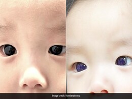 Baby's Dark-Brown Eyes Turn Blue After Covid-19 Treatment In Thailand: Report Baby's Dark-Brown Eyes Turn Blue After Covid-19 Treatment In Thailand: Report