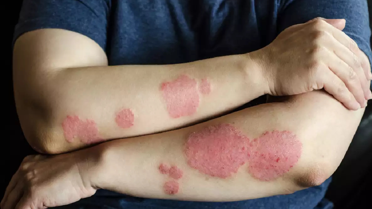 Sehat Ki Pathshala: Psoriasis के क्या हैं कारण और लक्षण, एसे करें बचाव