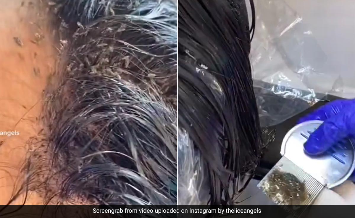 लाखों लीखों से भरा था लड़की का सिर, कंघी करते ही टपाटप गिरने लगा जुओं का झुंड, देखें वीडियो