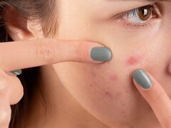 Dermatologist Shares 5 Game Changing Acne-Fighting Hacks