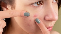 How To Prevent And Manage Active Pimples And Acne Scars