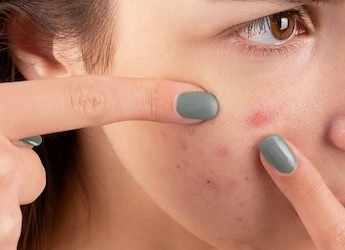 How To Prevent And Manage Active Pimples And Acne Scars
