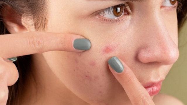 Skin Health: How To Prevent And Manage Active Pimples And Acne Scars