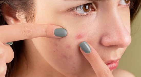 Skin Health: How To Prevent And Manage Active Pimples And Acne Scars