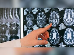 European Watchdog Partially Approves New Alzheimer's Drug