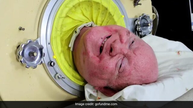 Paul Alexander, one of the two survivors of polio, using an iron lung