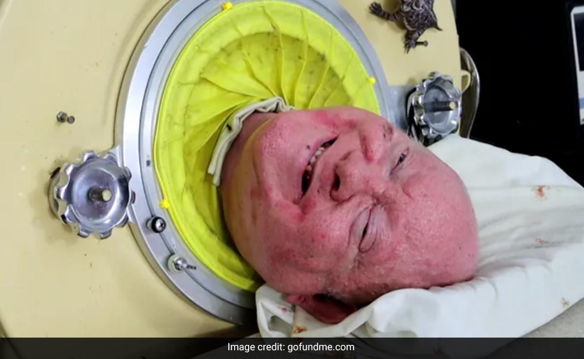 Paul Alexander, one of the two survivors of polio, using an iron lung