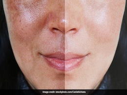 इस फल की पत्ती का पेस्ट लगाने से 15 दिन के अंदर चेहरे की झाई हो जाएगी गायब, रामबाण है रेमेडी इस फल की पत्ती का पेस्ट लगाने से 15 दिन के अंदर चेहरे की झाई हो जाएगी गायब, रामबाण है रेमेडी