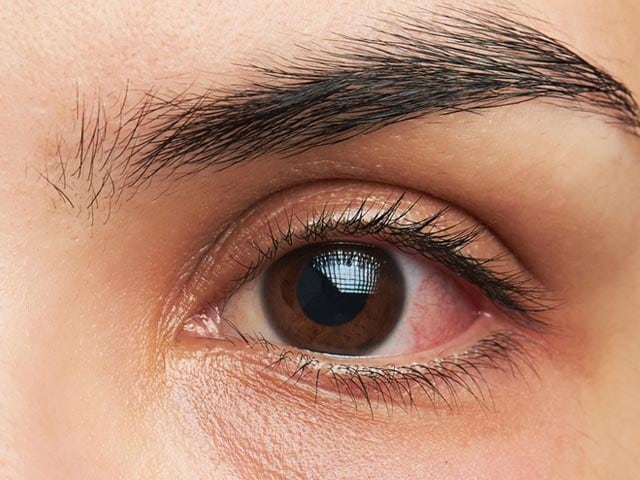 कंजंक्टिवाइटिस से कैसे बचें