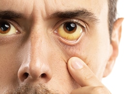 When Should You See A Doctor For Yellowing Of The Skin Or Eyes?