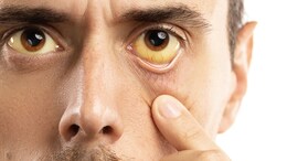 Is Jaundice Life-Threatening Or Life-Saving? Watch For These Signs Of An Underlying Disease