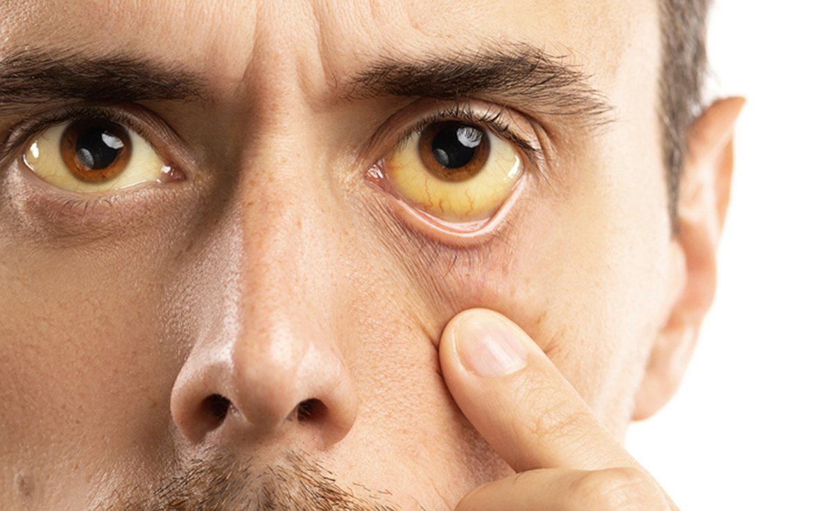 Is Jaundice Life-Threatening Or Life-Saving? Watch For These Signs Of An Underlying Disease