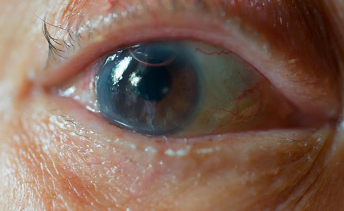 Месецът на осведомеността на катаракта се наблюдава всеки юни за