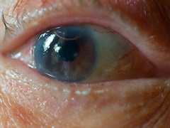 Cataracts Awareness Month 2025: When Should You See A Doctor?