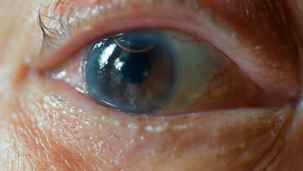 Cataracts: Watch Out For These Myths If You Wish To Get Operated