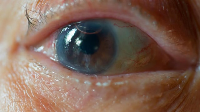 Cataracts Awareness Month 2025: It often cause colours to appear duller or more yellowed than usual