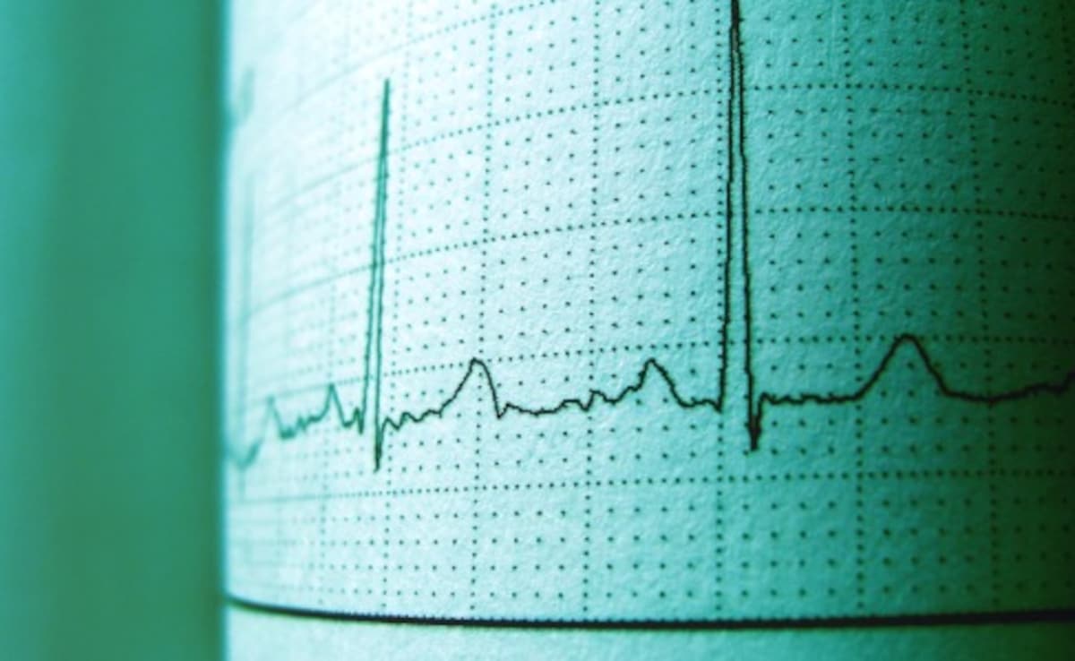AI-Based ECG Analysis Shows Higher Accuracy In Identifying Occlusive Heart Attack, Study Finds