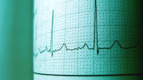 AI-Based ECG Analysis Shows Higher Accuracy In Identifying Occlusive Heart Attack, Study Finds