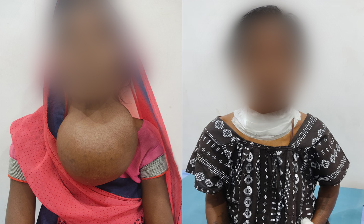 Rewa: नेशनल अस्पताल में महिला का किया गया सफल ऑपरेशन, गले से निकाली गई 7 किलो की गांठ