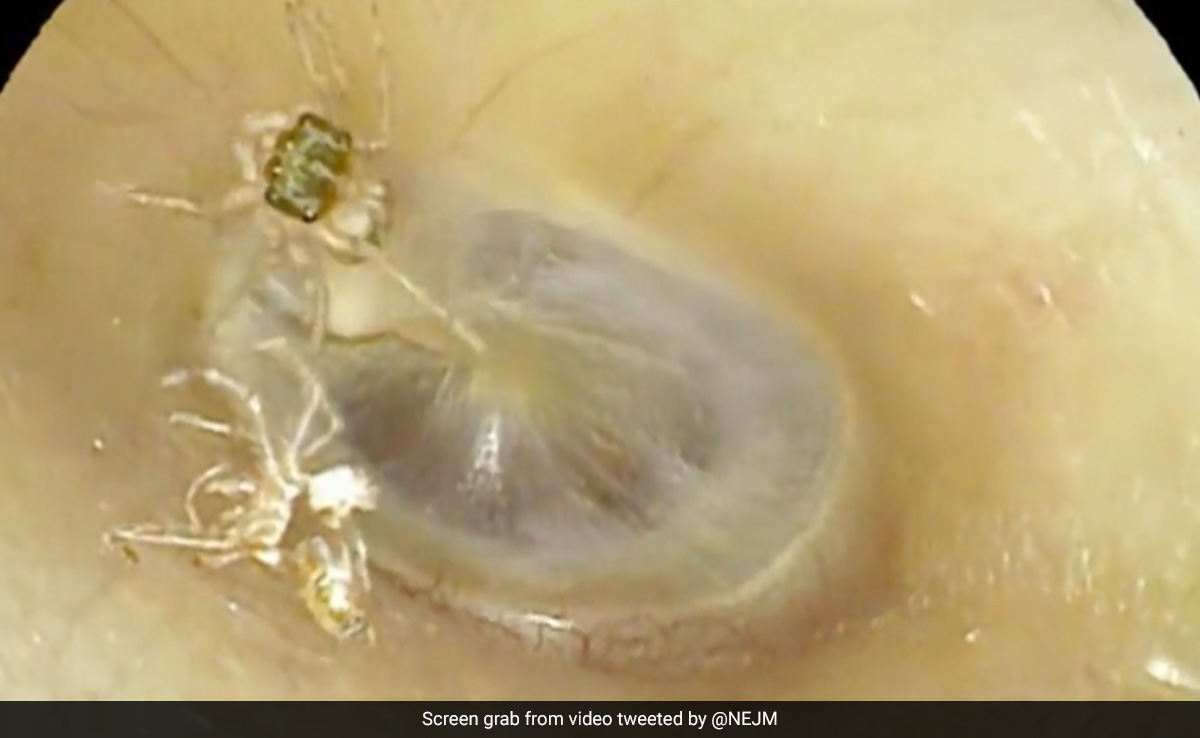 Watch: Woman Who Complained Of ''Abnormal Sounds'' Shocked To Find Spider Crawling In Her Ear