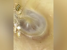 3-4 दिन से कान से आ रही थीं अजीब आवाजें, डॉक्टर को दिखाया अंदर से जो निकला वो बेहद डरावना था 3-4 दिन से कान से आ रही थीं अजीब आवाजें, डॉक्टर को दिखाया अंदर से जो निकला वो बेहद डरावना था