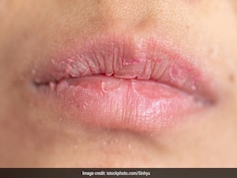 सर्दी आते ही फटने लगे हैं होंठ तो घर की ये 5 चीजें लगाना कर दें शुरू, मुलायम हो जाएंगे Chapped Lips  सर्दी आते ही फटने लगे हैं होंठ तो घर की ये 5 चीजें लगाना कर दें शुरू, मुलायम हो जाएंगे Chapped Lips