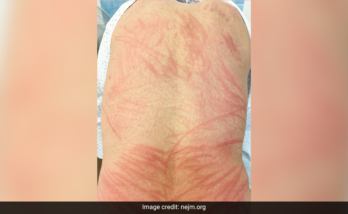 Man's Skin Turns Red And Blistery After Eating Undercooked Shiitake Mushrooms