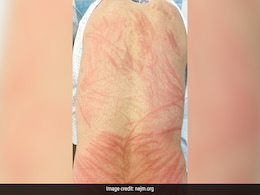 Man's Skin Turns Red And Blistery After Eating Undercooked Shiitake Mushrooms Man's Skin Turns Red And Blistery After Eating Undercooked Shiitake Mushrooms
