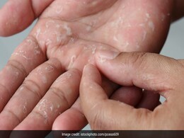 Causes of Hand Peeling: सर्दियों में क्यों निकलने लगती है हाथों की चमड़ी? हाथों की खाल उतरने के कारण, लक्षण और बचाव के आसान तरीके Causes of Hand Peeling: सर्दियों में क्यों निकलने लगती है हाथों की चमड़ी? हाथों की खाल उतरने के कारण, लक्षण और बचाव के आसान तरीके