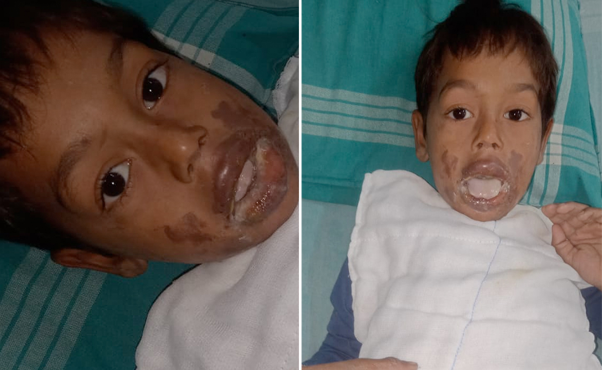 पुरानी रंजिश में 6 वर्षीय बच्चे को पिलाया कोल्ड ड्रिंक मिली तेजाब, अंदर तक झुलस गया मासूम का मुंह