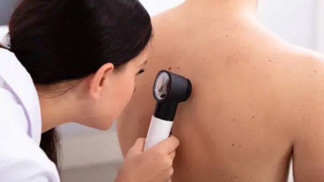 Kiran Sethi urges viewers to self-check their moles every month or visit a doctor every 6 months