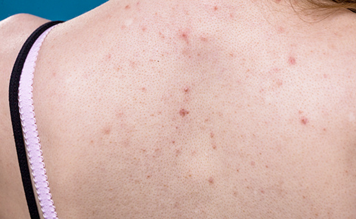 पीठ पर हो गए हैं दाने तो घर की ही चीजों से तैयार कर लें ये स्क्रब, कुछ दिन के इस्तेमाल से ही दूर होगी Bacne की दिक्कत 