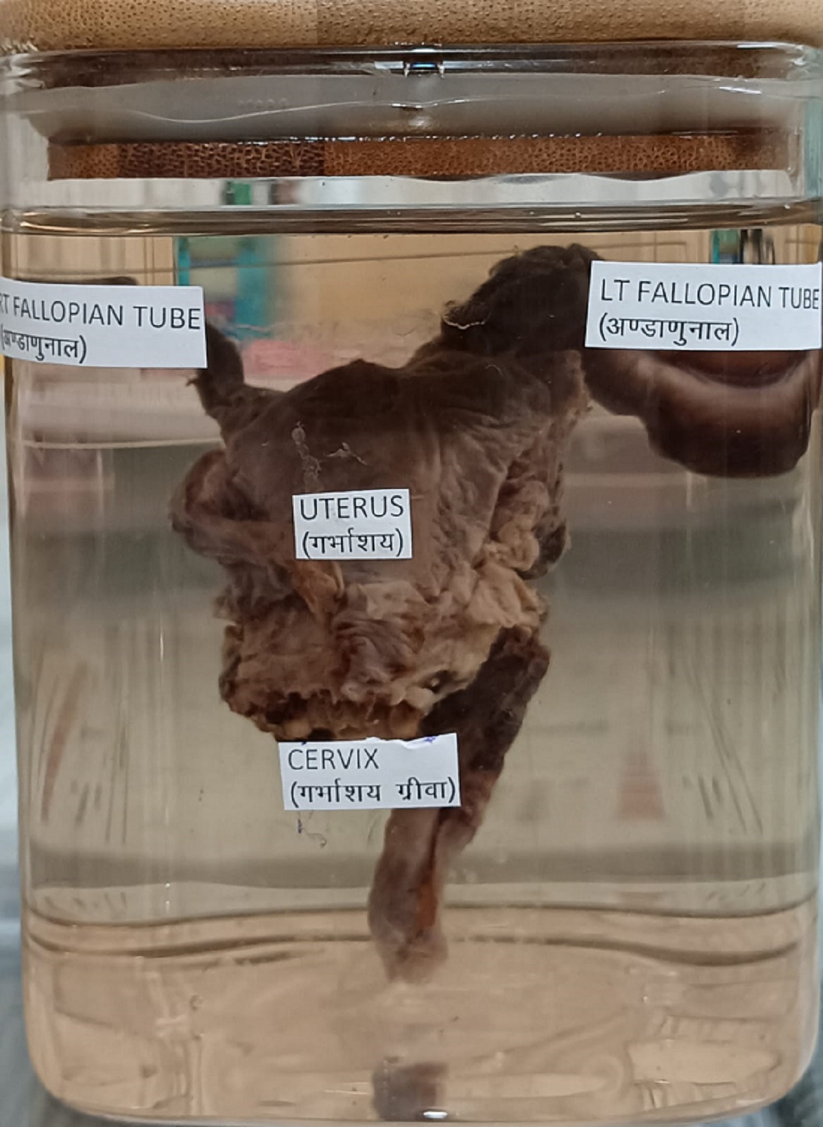 Rare Case : धमतरी में डॉक्टर हुए हैरान, ऑपरेशन कर  27 वर्षीय युवक के पेट से निकाला गर्भाशय