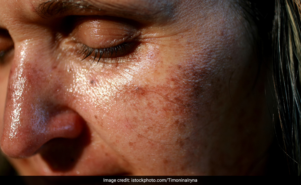 गालों पर दिखने वाली झाइयों को हटाने के लिए एलोवेरा में मिलाकर रोजाना लगाएं यह चीज, धब्बे होने लगेंगे हल्के 