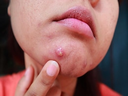 Get rid of Acne/Pimples: डॉक्टर ने बता दिया पिंपल्स के पीछे का सबसे बड़ा कारण, जान लें कैसे ठीक करें सर्दियों में निकलने वाले मुंहासों को Get rid of Acne/Pimples: डॉक्टर ने बता दिया पिंपल्स के पीछे का सबसे बड़ा कारण, जान लें कैसे ठीक करें सर्दियों में निकलने वाले मुंहासों को