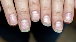 This Is What These Fingernail Abnormalities Indicate