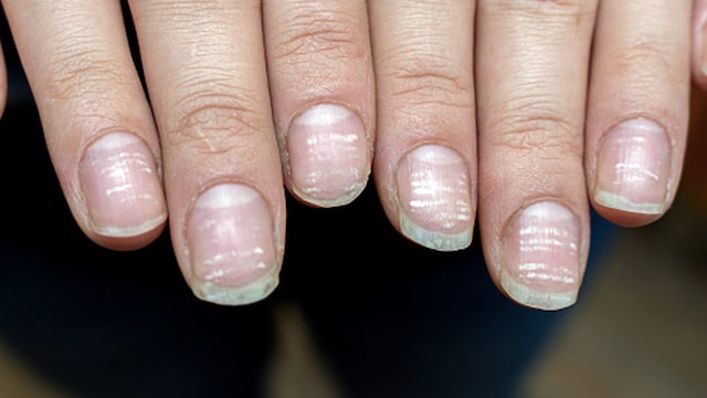 Pale or white nails may indicate anaemia, a condition where there is a deficiency of red blood cells