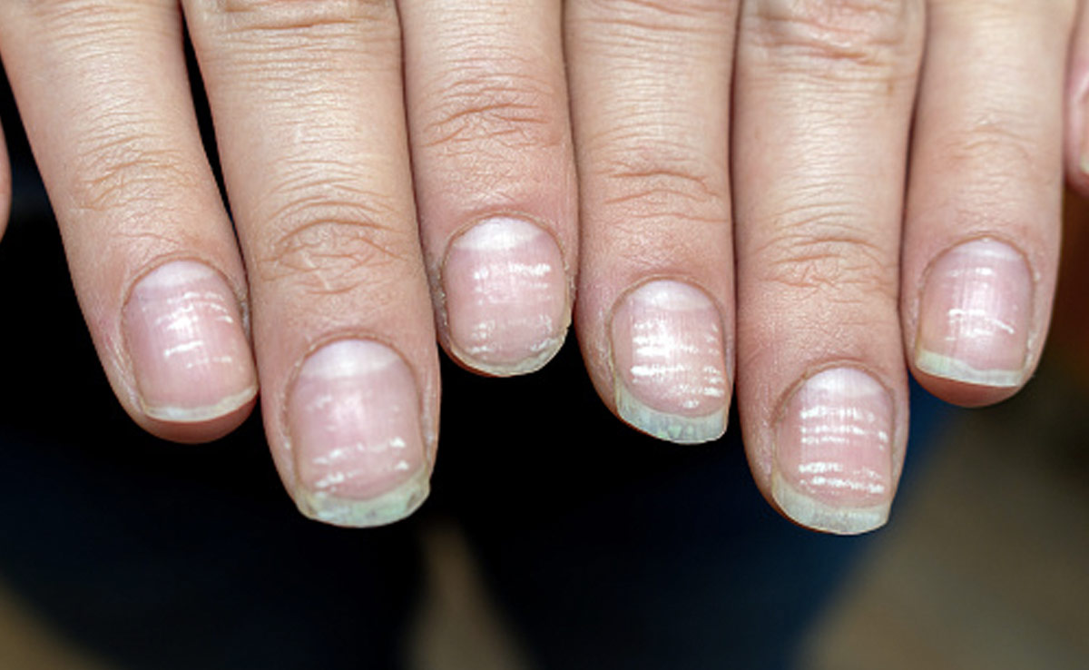 Pale or white nails may indicate anaemia, a condition where there is a deficiency of red blood cells