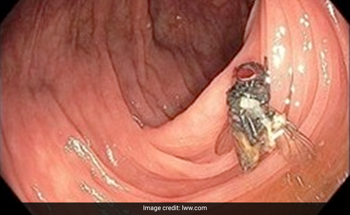 US Doctors Find Fully Intact House Fly Inside 63-Year-Old Man's Intestines