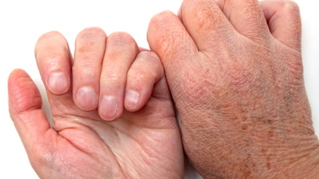 Dry Hands Due To Winter Cold? 10 Things You Need To Fix Fast