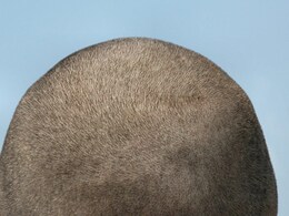 डॉक्टर ने बताया अगर गंजे हैं तो 4 बूंद इस तेल की डालकर कर लें मसाज रोज रात में, 15 दिन में उगने लगेंगे बाल