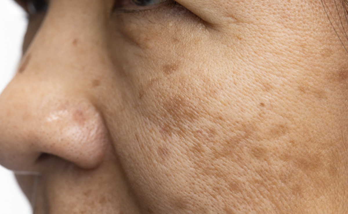 आपके भी चेहरे या गर्दन पर हो गए हैं भूरे रंग के धब्बे, डॉक्टर से जानें क्या हैं ये और कैसे करें इसे ठीक