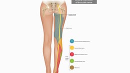 How To Manage And Prevent Painful Sciatica? Nutritionist Explains